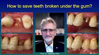 How to save teeth broken under the gum [upl. by Yrallih]