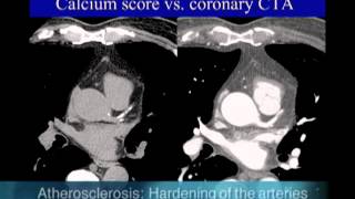 UCSF Radiology Calcium Scoring vs Coronary CTA Scan [upl. by Nythsa]