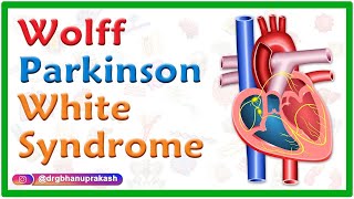 WolffParkinsonWhite Syndrome WPW  Causes Mechanism ECG Findings and diagnosis Treatment [upl. by Glaudia]