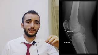 LL Patellar fracture l كسر عظم الرضفة [upl. by Adnawahs]