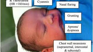 Hyaline membrane diseaserisk factor clinical features sign and symptoms [upl. by Seyler633]