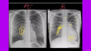 CONGENITAL HEART DISEASES amp EISENMENGER SYNDROME HOW TO APPROACH ON CHEST RADIOGRAPh BY DR NAEEM🚦 [upl. by Siloa]