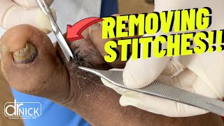 How to remove Stitches Not Medical Advice [upl. by Aihseyk]