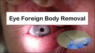 Eye Foreign Body Removal [upl. by Matusow]