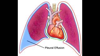 Pleural Effusions  Transudate Exudate amp Lymphatic [upl. by Alimaj334]