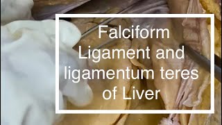 Peritoneum Falciform ligament Ligamentum teres of Liver [upl. by Martguerita]