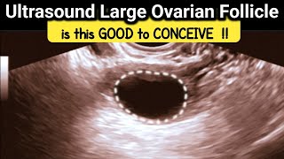 what is Large Ovarian Follicle  is it GOOD to CONCEIVE  TVS Ultrasound [upl. by Arad]