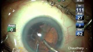 Micro incision cataract surgery MICS by phaco at Eye7 Delhi India [upl. by Anaujait]