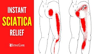 How to Instantly Fix Sciatica Pain [upl. by Airretnahs]