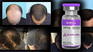 Could Copper Peptides Reverse Hair Loss and Inflammation [upl. by Afaw]