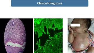 Epidermolysis Bullosa  Spot Diagnosis  9  Pediatrics [upl. by Parris]