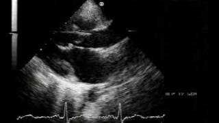 echocardiogramchordal rupture 12 [upl. by Alton]