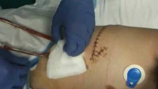 Rideys chest tube removal [upl. by Hamrnand488]