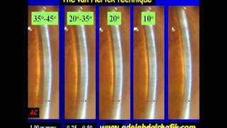 Gonioscopy Lecture part 08 [upl. by Lebasiram]