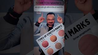 Stretch Marks ManagementTreatmentBest Stretch Marks Treatment stretchmarksskincareproducts [upl. by Uehttam82]