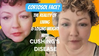 Cortisol Face Living and Losing Weight with Cushings DiseaseSyndrome [upl. by Christye]