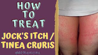 HOW TO TREAT JOCKS ITCH  TINEA CRURIS [upl. by Mathilda]