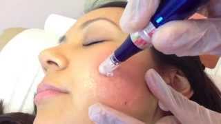 Micro Needling SkinPen for acne scarring [upl. by Kilgore600]