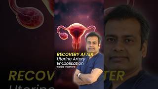 Recovery after Uterine Artery Embolisation  Recovery Time after Uterine Fibroid Embolization UFE [upl. by Kobylak]