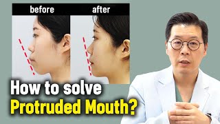 ENJP How to solve Protruded Mouth l Korean Protruded Mouth surgery case review [upl. by Eugilegna618]