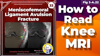 Fig 3A22 Meniscofemoral Ligament Avulsion Fracture [upl. by Adnama]