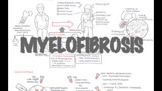 Primary Myelofibrosis  Overview presentation pathophysiology investigation treatment [upl. by Elyrehc]