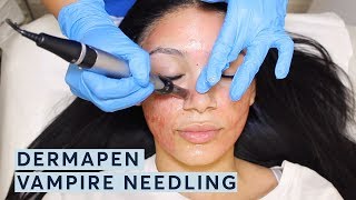 Dermapen  Vampire Needling Treatment [upl. by Novar205]