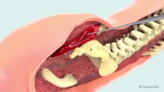 Augmentation des fesses en 3D Implant glutéal à Marseille 13BouchesduRhône [upl. by Deelaw]