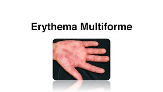 Erythema Multiforme  Causes Complications amp Treatment [upl. by Merilyn]