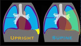 Imaging of pleural effusion For medical students clinicans and residents [upl. by Ibba]