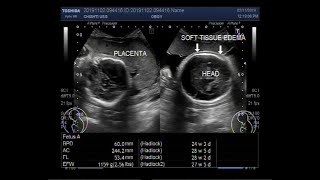 Ultrasound Video showing Microcephaly  small head  associated with microencephaly small brain [upl. by Zalea]