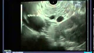 Radial Endoscopic Ultrasound  Anatomical Guiding Structures in the Upper Abdomen [upl. by Ynnoj]