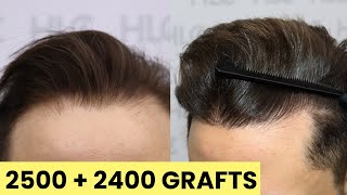 FUE Hair Transplant and Beard Transplant in Turkey  4900 Grafts [upl. by Leonie970]