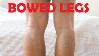 how to get rid of bowed legs without surgery [upl. by Andeee208]