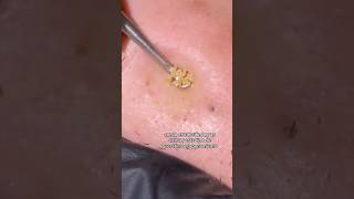 Extracción de Espinillas y Comedones acne facial rostro [upl. by Teik]