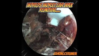 Most Disgusting Ear Wax Removal [upl. by Gnilrits119]