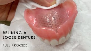 Relining a Loose Denture  Full Process [upl. by Inasah133]