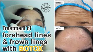 Botox Before And After  Botox Injections  Treatment of Forehead Lines and Frown Lines with Botox [upl. by Themis]