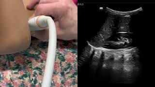 Pediatric RenalBladder Scan Demo R kidney long axis [upl. by Silenay]