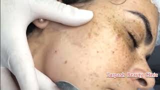 Remove Dead Skin From The Face at Zarpash Beauty Clinic [upl. by Brindle473]