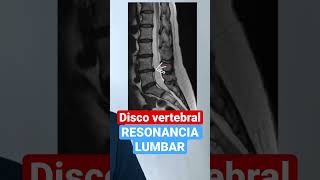 Resonancia Magnética 🧲 Lumbar 11 dolordeespalda radiologia herniadedisco 👇 [upl. by Ssidnak]