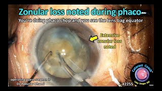 CataractCoach™ 2255 zonular loss noted during phaco [upl. by Melak]