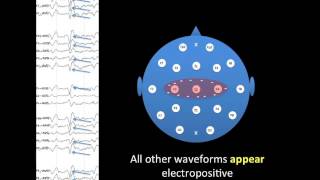 EEG Montages [upl. by Caspar637]