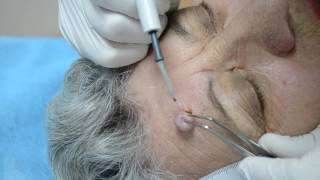 Intra dermal nevus  removal by highfrequency electrosurgery [upl. by Anilehs550]