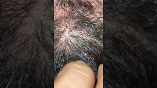 In ingrownhairremoval barber ingrownhair asmr skincare [upl. by Audrye]