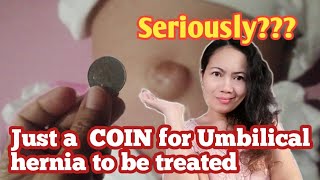 HOW SERIOUS IS UMBILICAL HERNIA Lorena Jordan Orejola umbilicalhernia homeremedieS [upl. by Sutniuq]