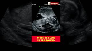 week 18 ultrasound scan  pregnancy week by week  3d scan [upl. by Niwde]