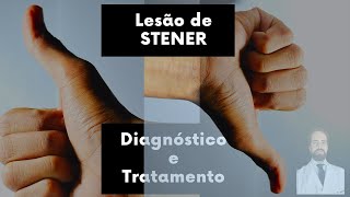 Lesão de Stener  Diagnóstico e Tratamento [upl. by Tima494]