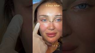 Scarless facelift by DrTAS🚀 [upl. by Asha]