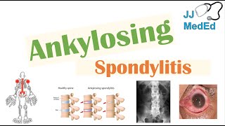 Ankylosing Spondylitis  HLAB27 Pathophysiology Signs amp Symptoms Diagnosis Treatment [upl. by Benia]